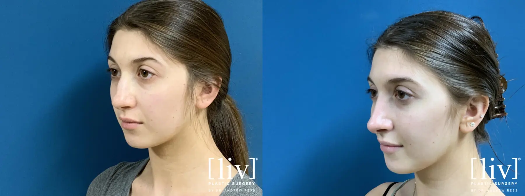 Rhinoplasty: Patient 23 - Before and After 2