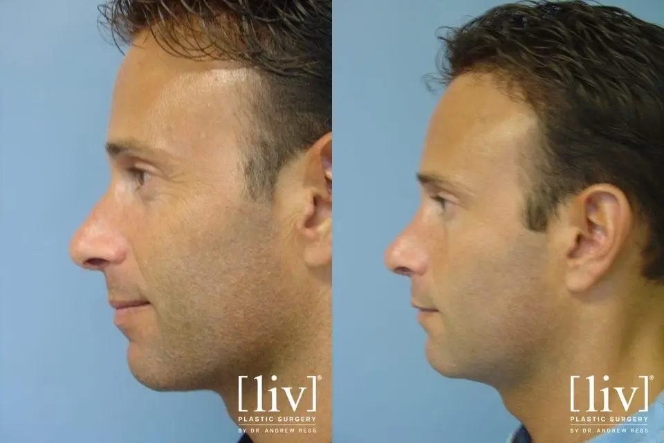 Rhinoplasty: Patient 21 - Before and After 3