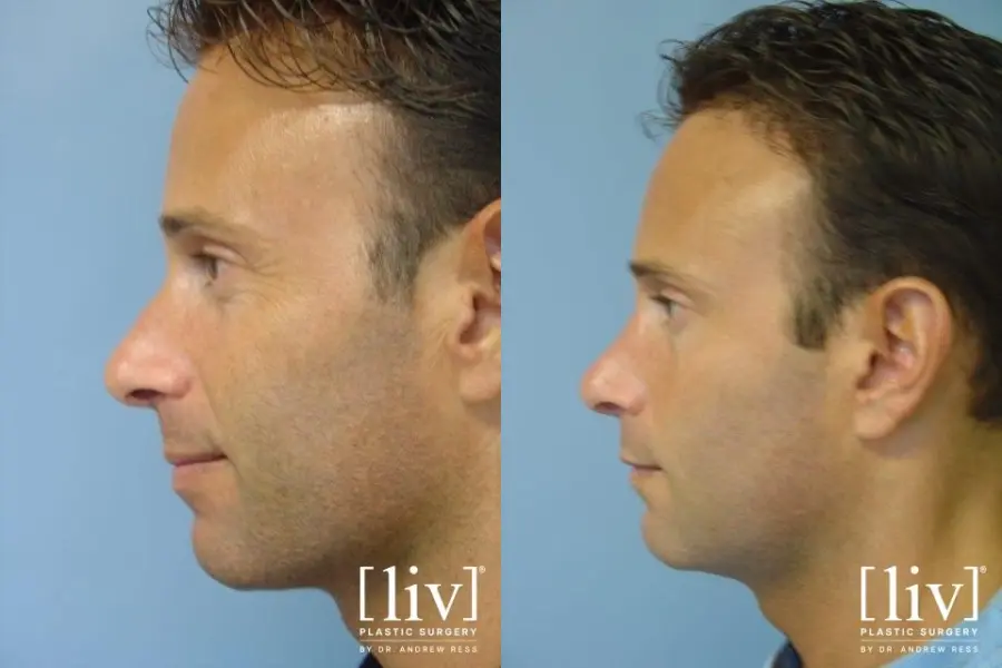 Rhinoplasty: Patient 13 - Before and After 3