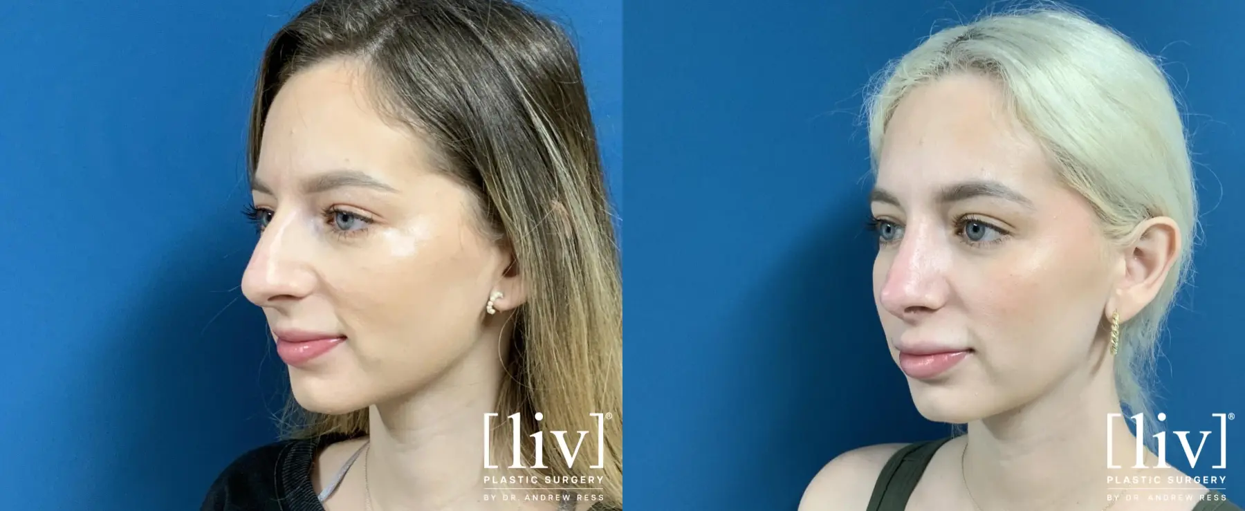 Rhinoplasty: Patient 1 - Before and After 2