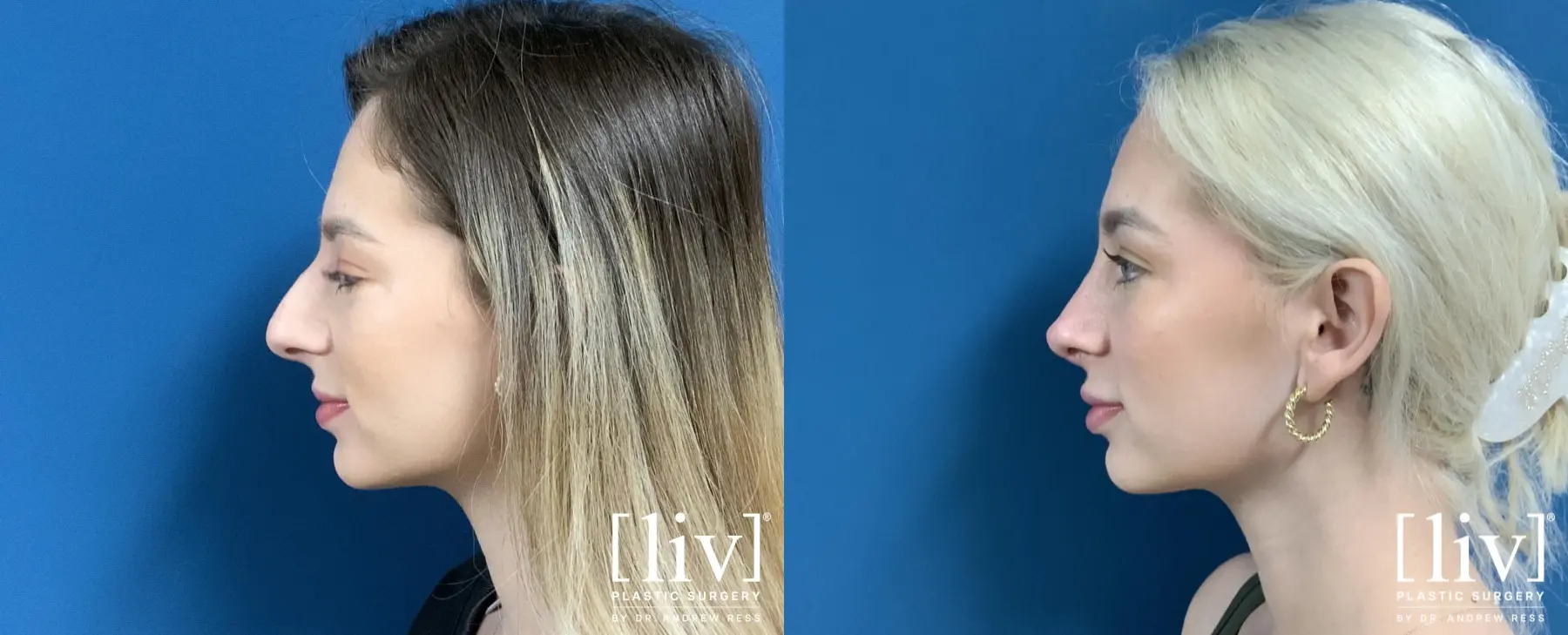 Rhinoplasty: Patient 1 - Before and After 1