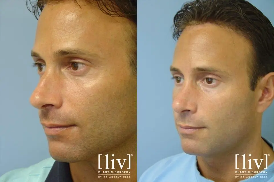 Rhinoplasty: Patient 21 - Before and After 2