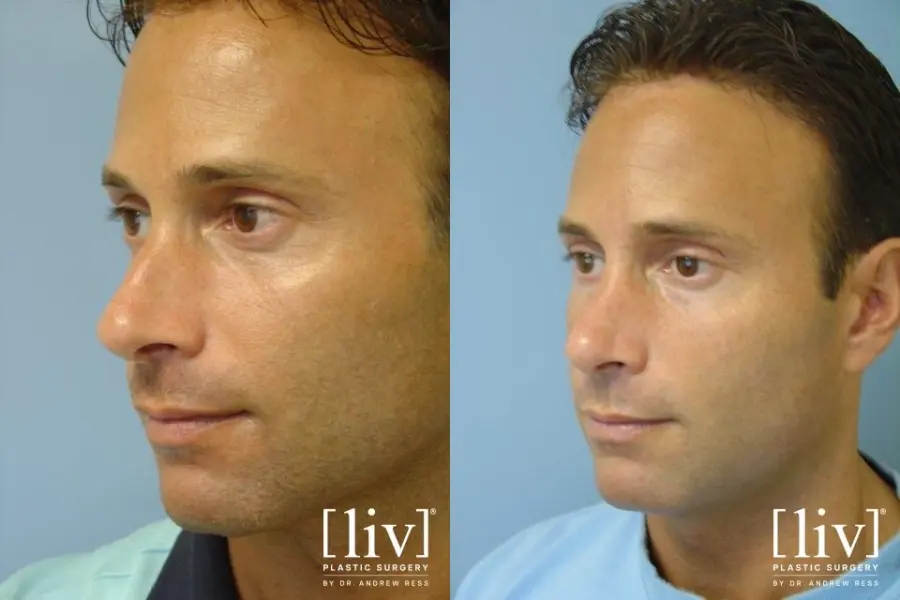 Rhinoplasty: Patient 13 - Before and After 2