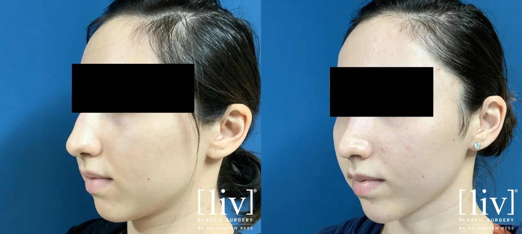 Rhinoplasty: Patient 6 - Before and After 2