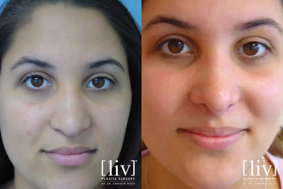 Rhinoplasty: Patient 17 - Before and After 1