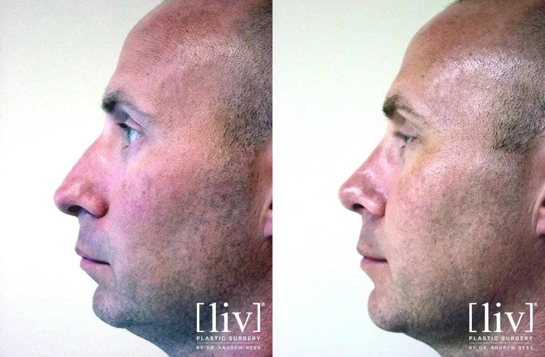 Rhinoplasty: Patient 18 - Before and After 5