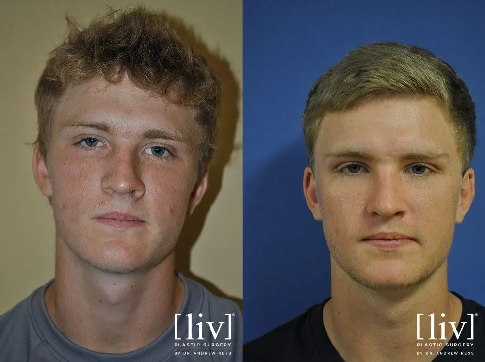 Rhinoplasty: Patient 13 - Before and After 1