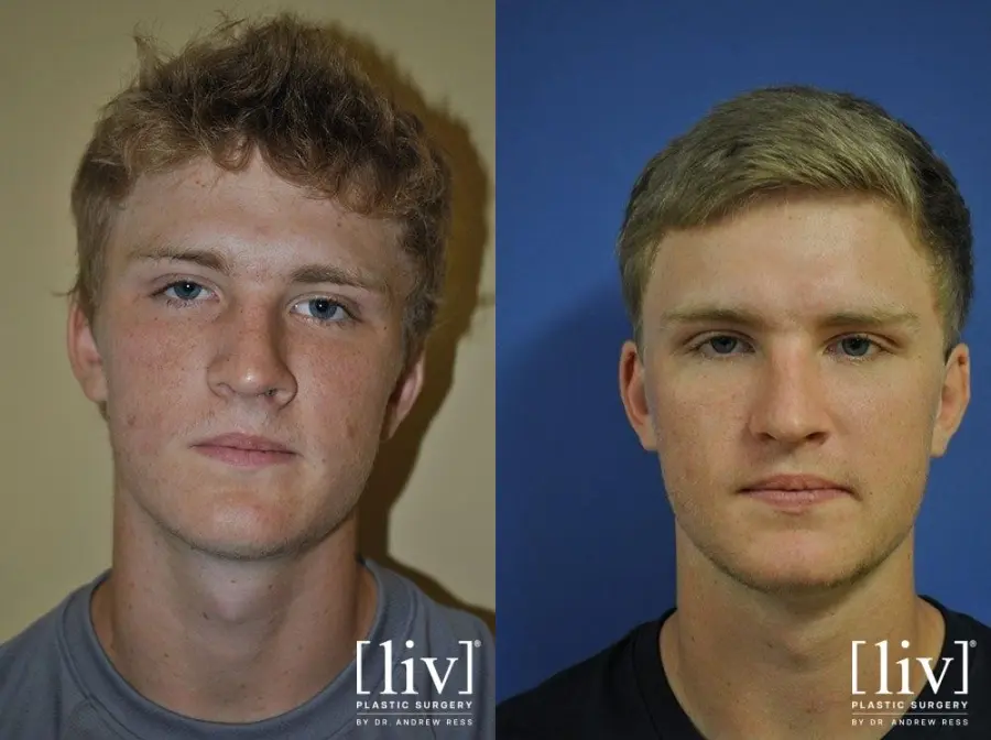 Rhinoplasty: Patient 4 - Before and After 1