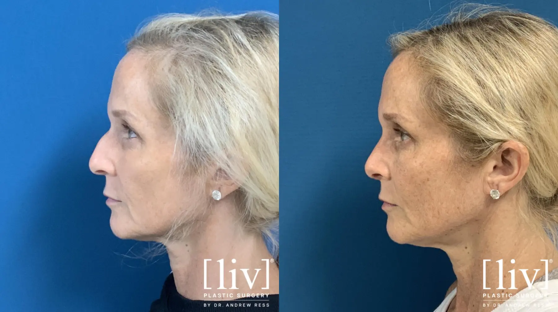 Rhinoplasty: Patient 3 - Before and After 1