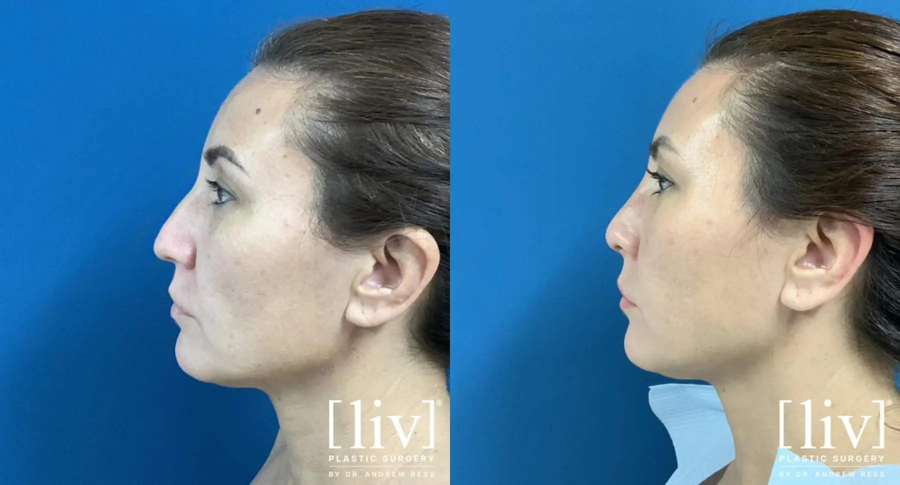 Rhinoplasty: Patient 7 - Before and After 1