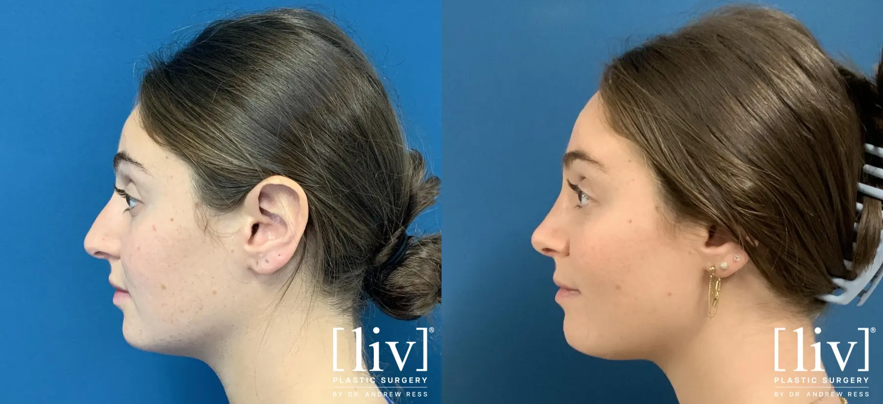 Rhinoplasty: Patient 24 - Before and After 1
