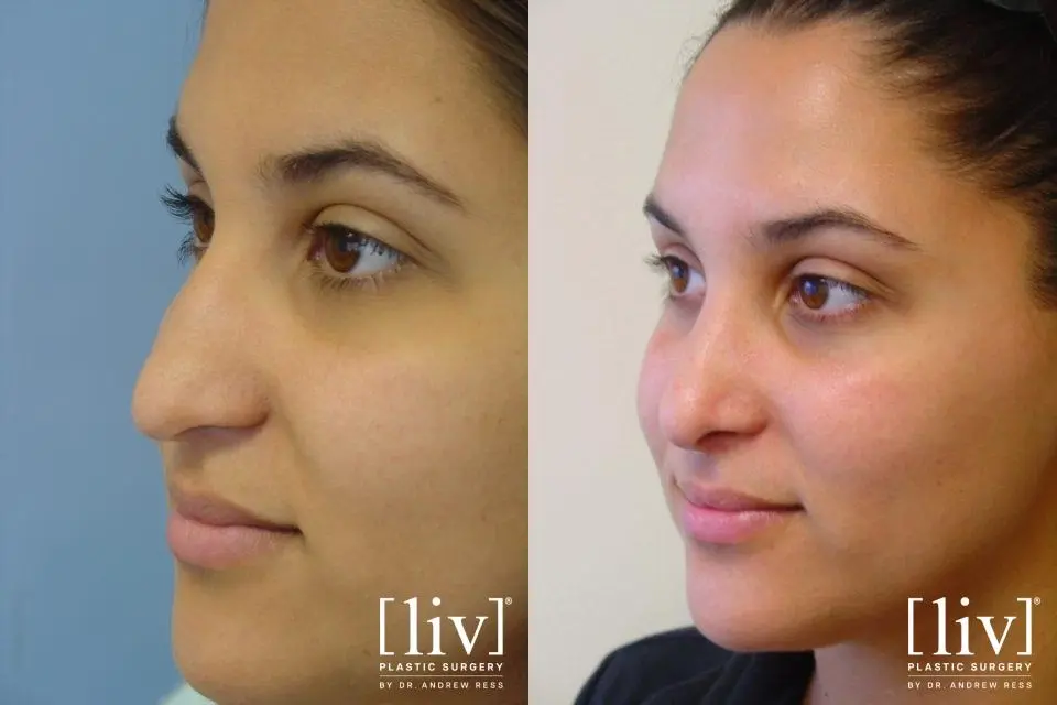 Rhinoplasty: Patient 17 - Before and After 2