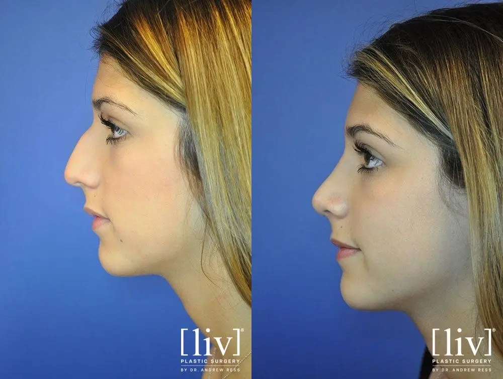 Rhinoplasty: Patient 10 - Before and After 3