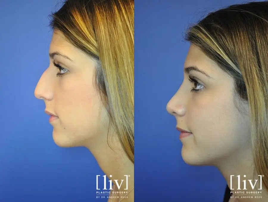 Rhinoplasty: Patient 15 - Before and After 3