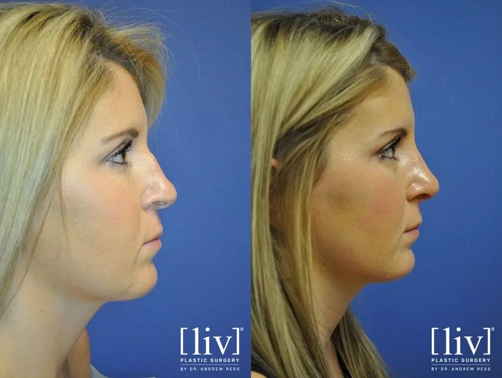 Rhinoplasty: Patient 18 - Before and After 3