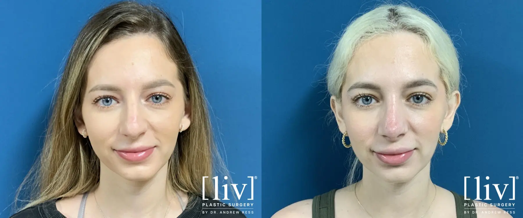 Rhinoplasty: Patient 1 - Before and After 3