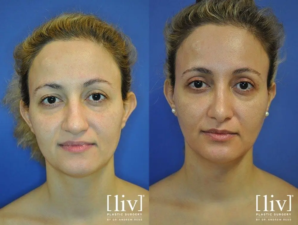 Rhinoplasty: Patient 13 - Before and After 1