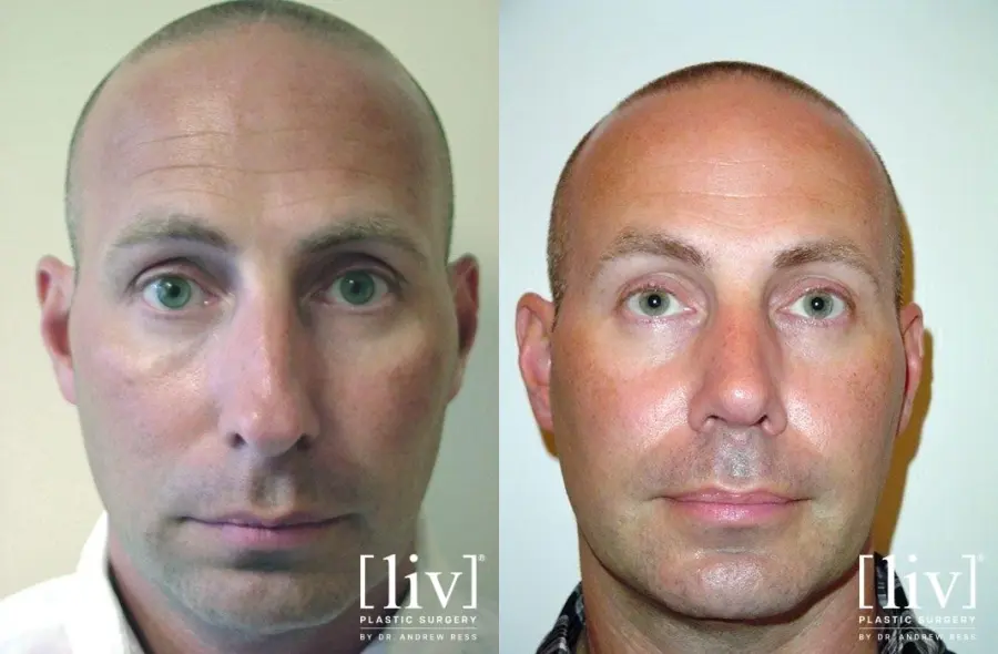 Rhinoplasty: Patient 12 - Before and After 1