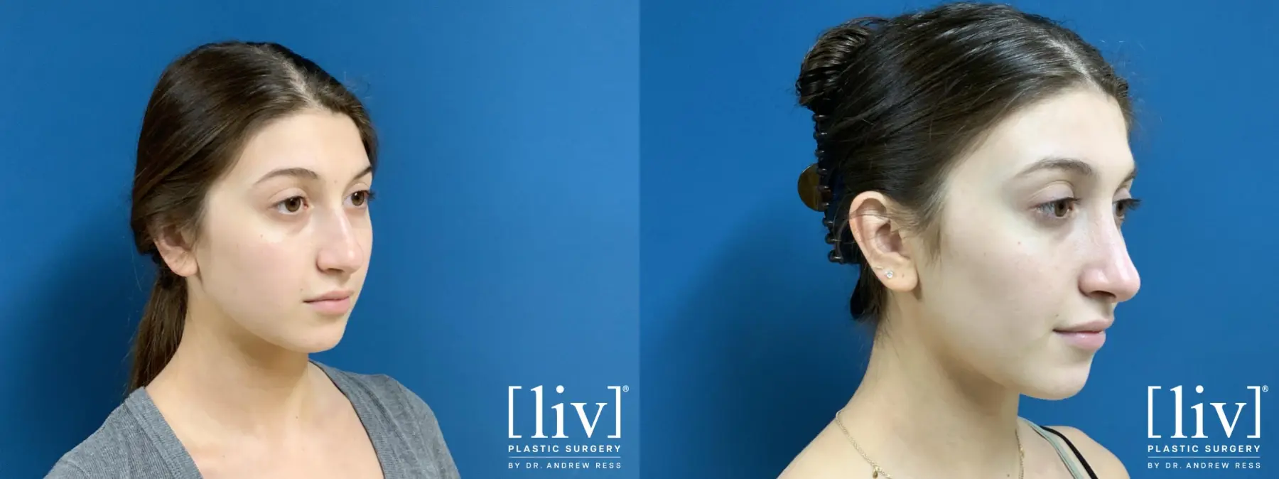 Rhinoplasty: Patient 23 - Before and After 4