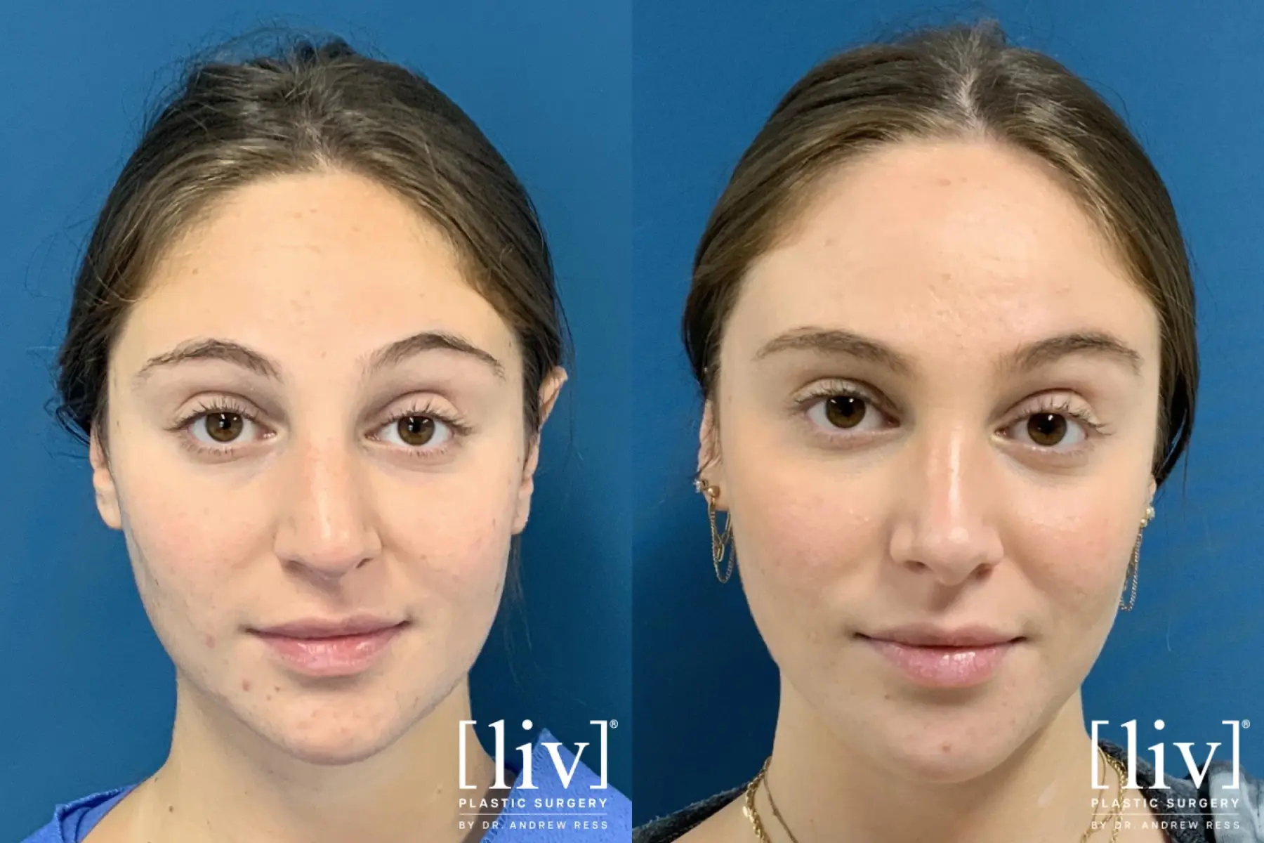 Rhinoplasty: Patient 24 - Before and After 3