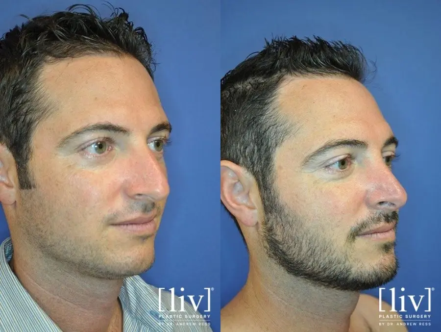 Rhinoplasty: Patient 16 - Before and After 2