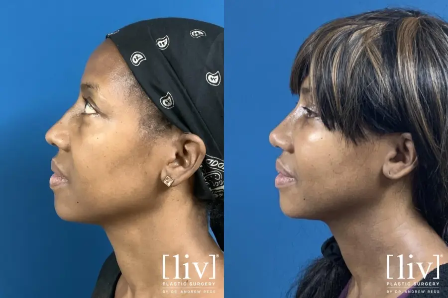 Rhinoplasty: Patient 17 - Before and After 3