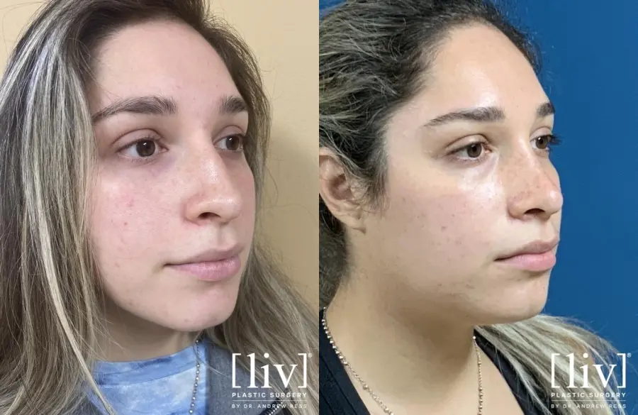 Rhinoplasty: Patient 18 - Before and After 2
