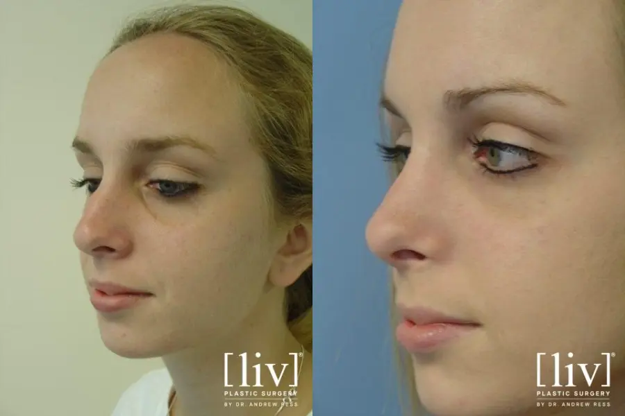 Rhinoplasty: Patient 11 - Before and After 2