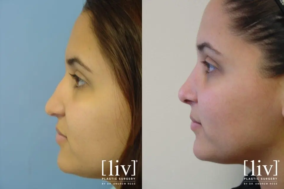 Rhinoplasty: Patient 17 - Before and After 3