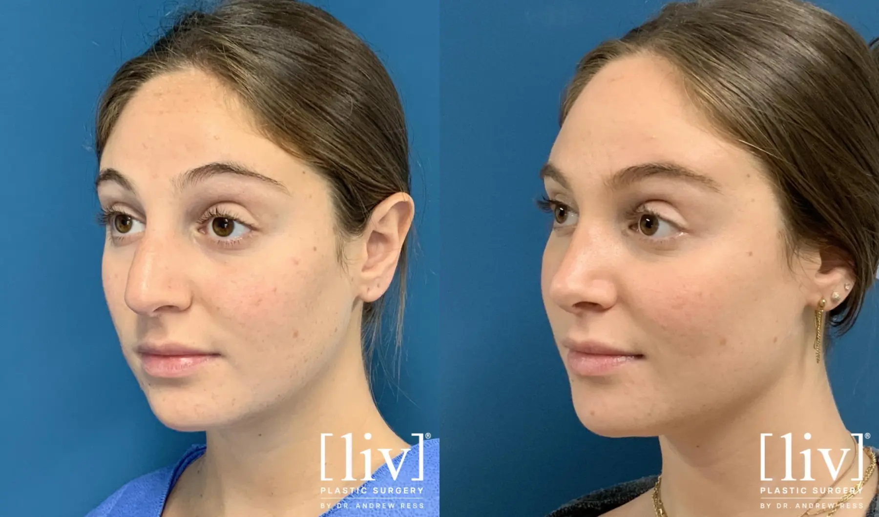 Rhinoplasty: Patient 24 - Before and After 2