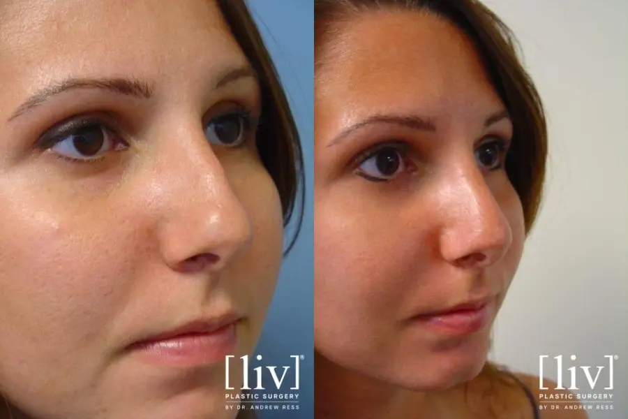Rhinoplasty: Patient 2 - Before and After 2