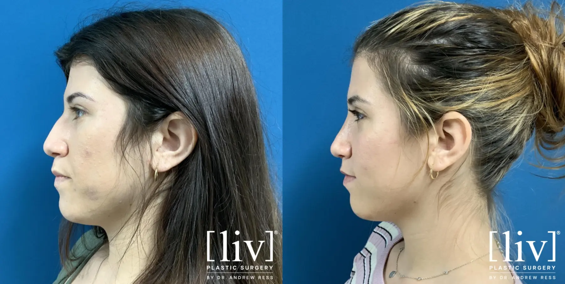 Rhinoplasty: Patient 6 - Before and After 3