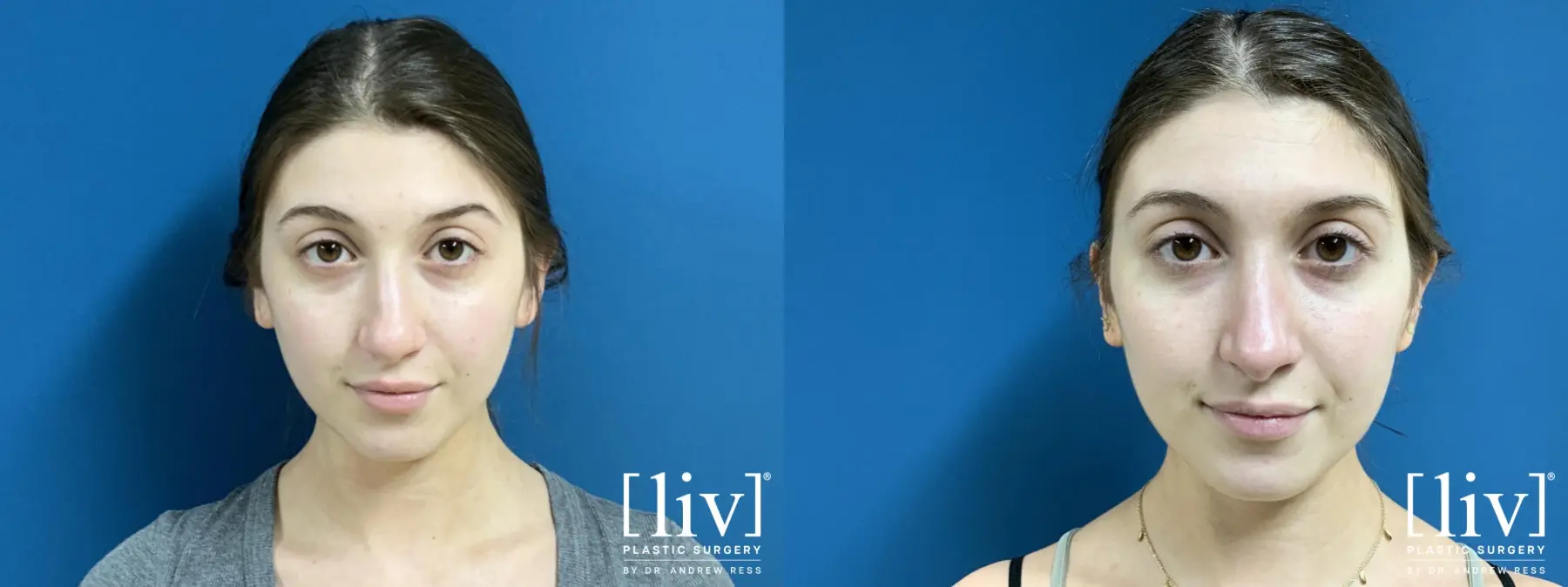 Rhinoplasty: Patient 23 - Before and After 3