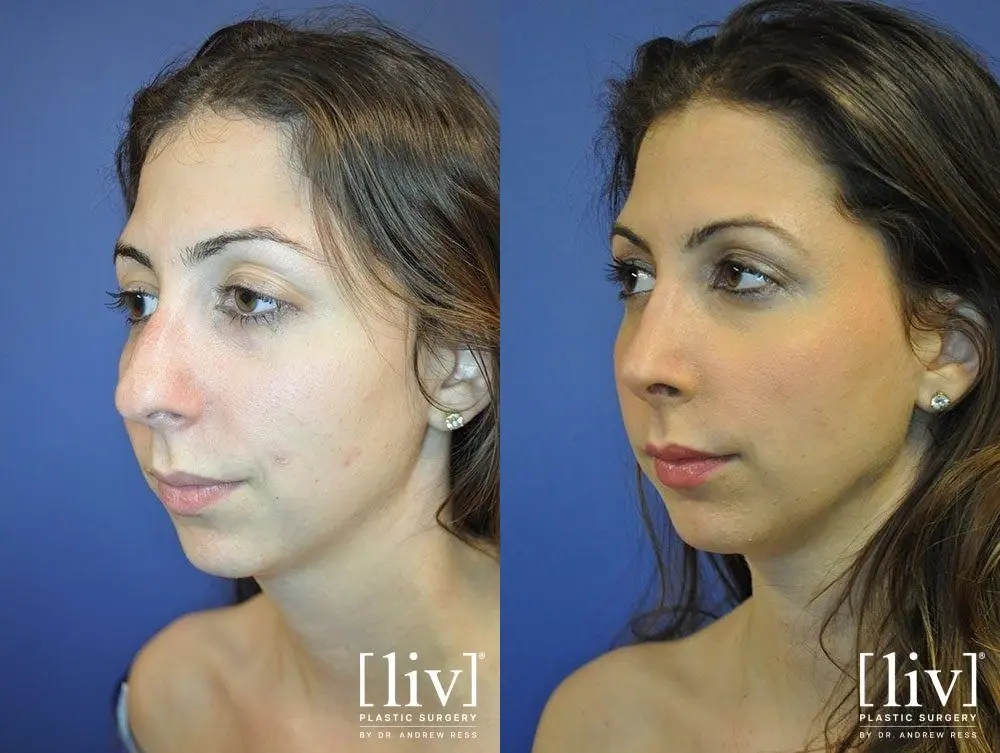 Rhinoplasty: Patient 16 - Before and After 2