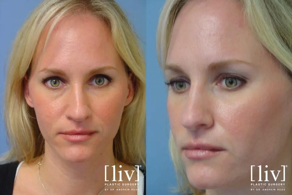 Rhinoplasty: Patient 22 - Before and After 1