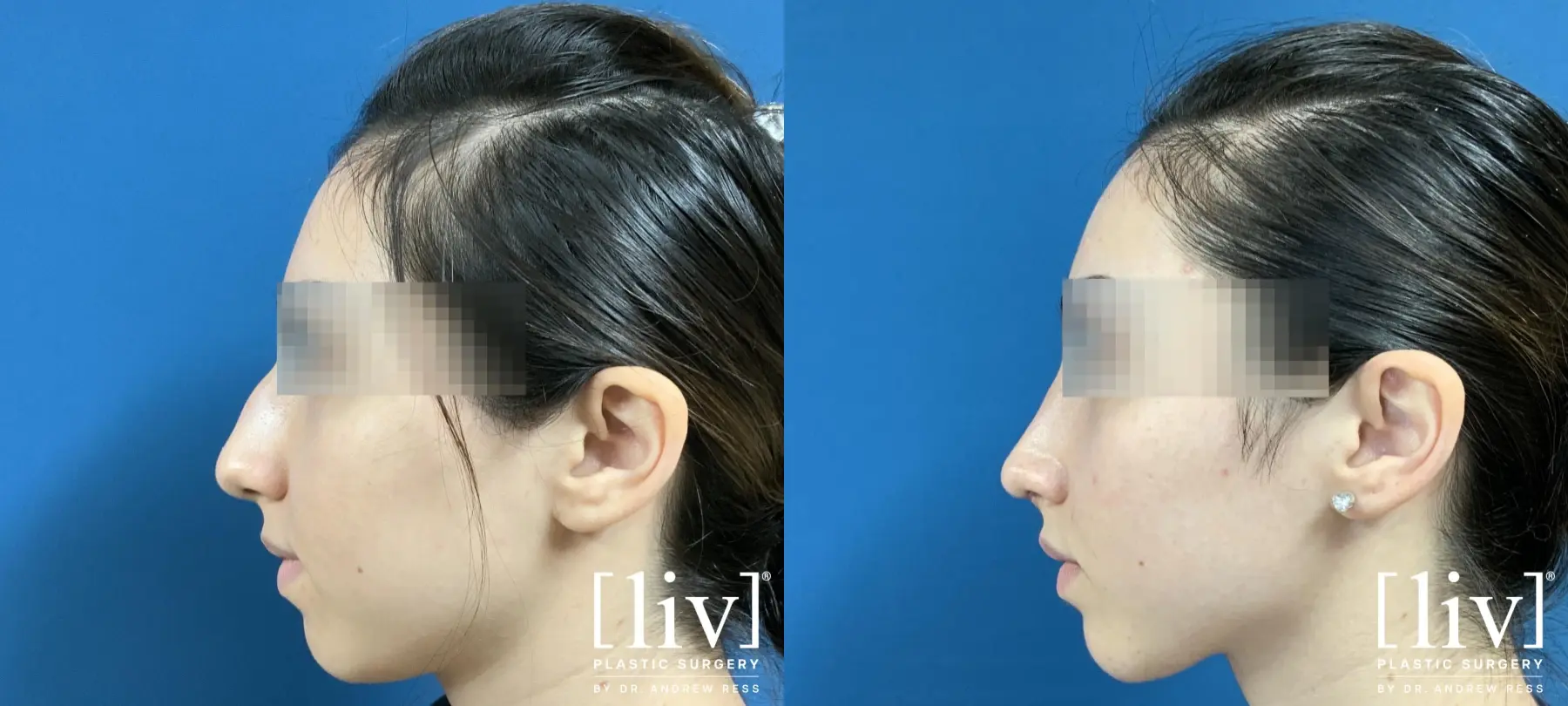 Rhinoplasty: Patient 6 - Before and After 1
