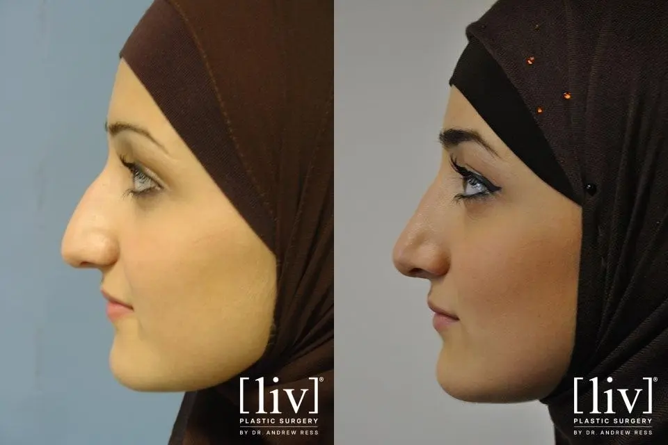 Rhinoplasty: Patient 5 - Before and After 3