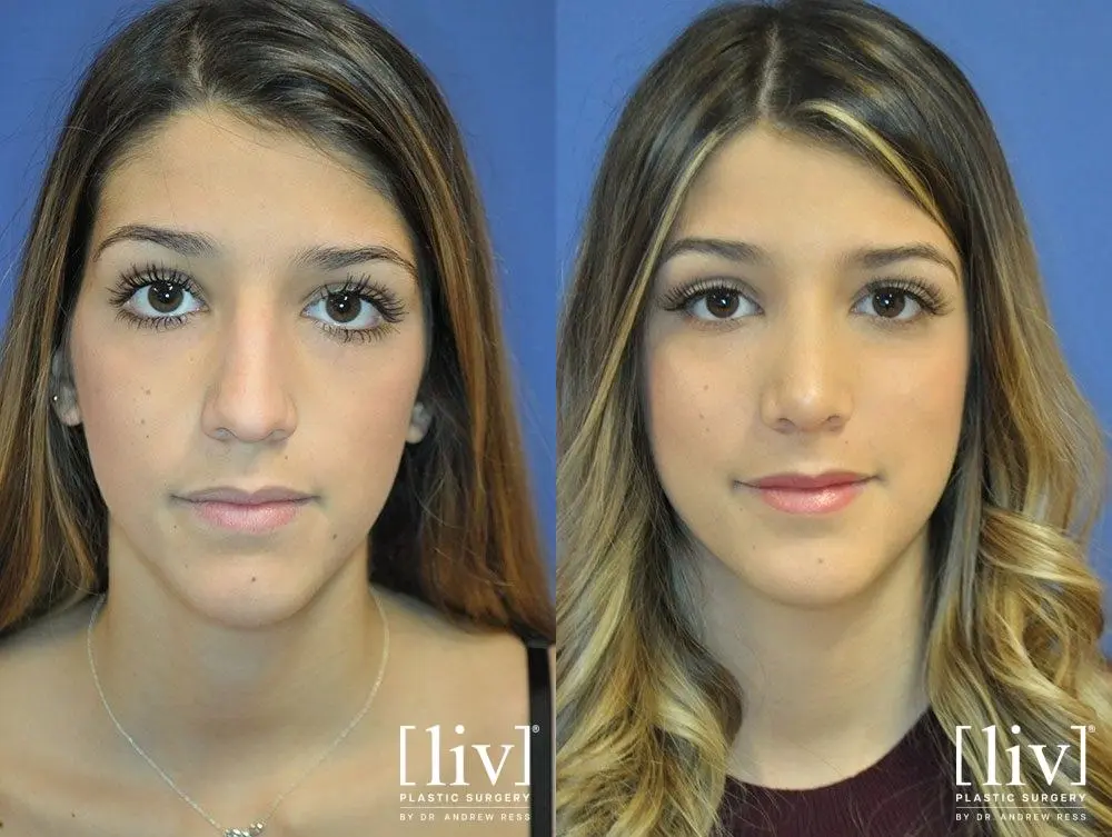 Rhinoplasty: Patient 10 - Before and After 1