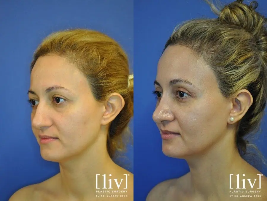Rhinoplasty: Patient 6 - Before and After 4