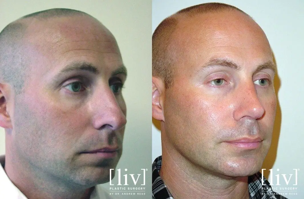 Rhinoplasty: Patient 18 - Before and After 2