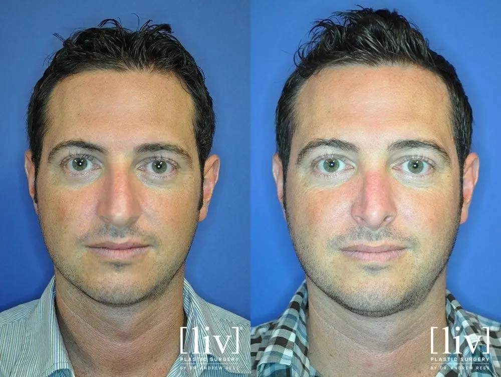 Rhinoplasty: Patient 23 - Before and After 3