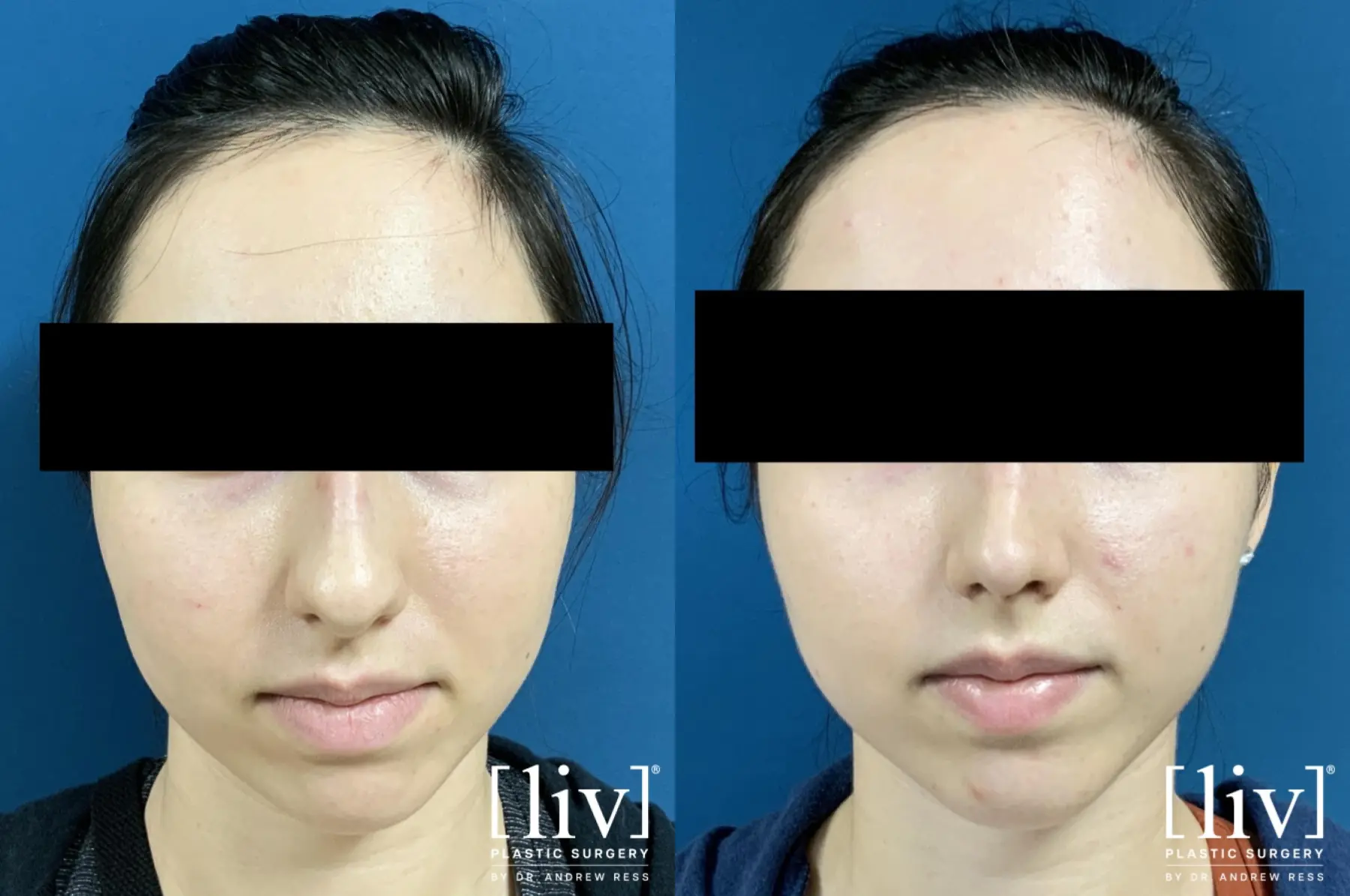 Rhinoplasty: Patient 6 - Before and After 3