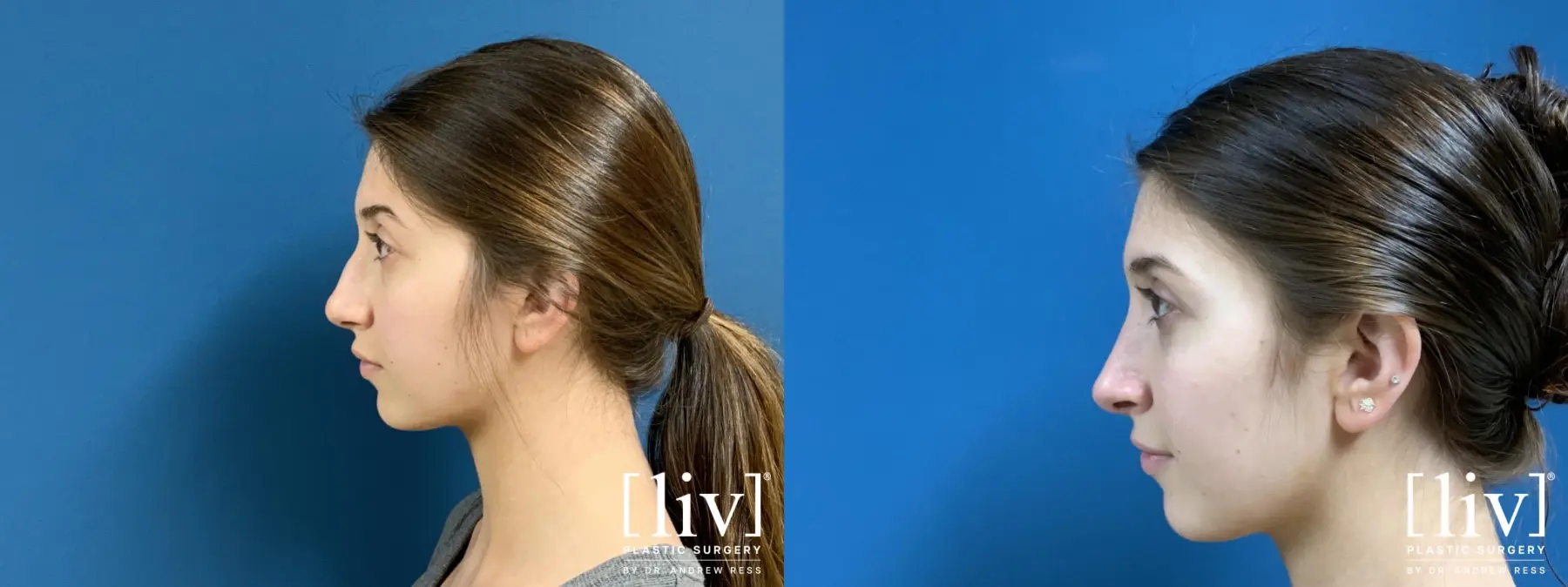 Rhinoplasty: Patient 23 - Before and After 1