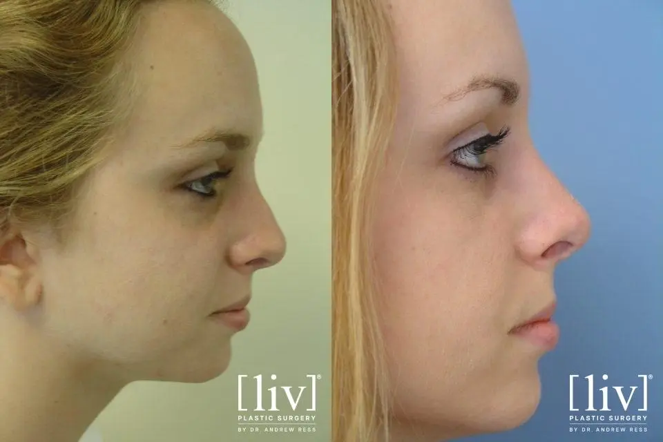 Rhinoplasty: Patient 17 - Before and After 3
