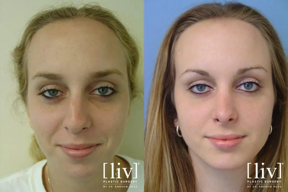 Rhinoplasty: Patient 17 - Before and After 1