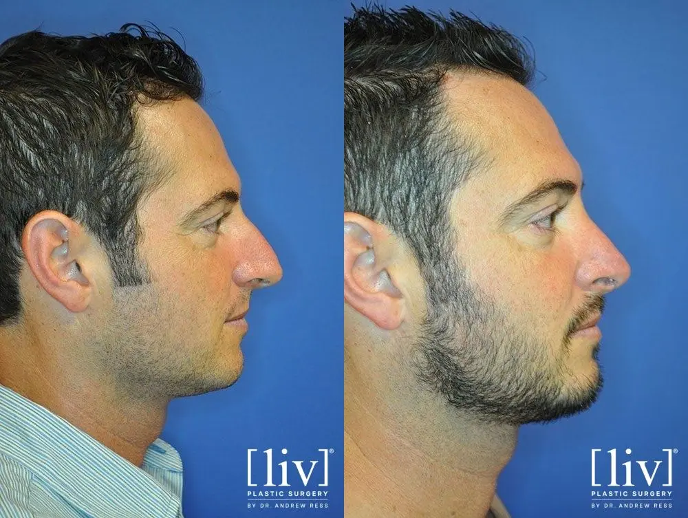 Rhinoplasty: Patient 23 - Before and After 1