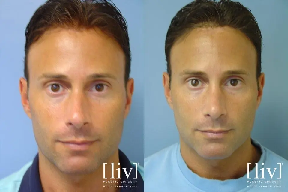 Rhinoplasty: Patient 21 - Before and After 1