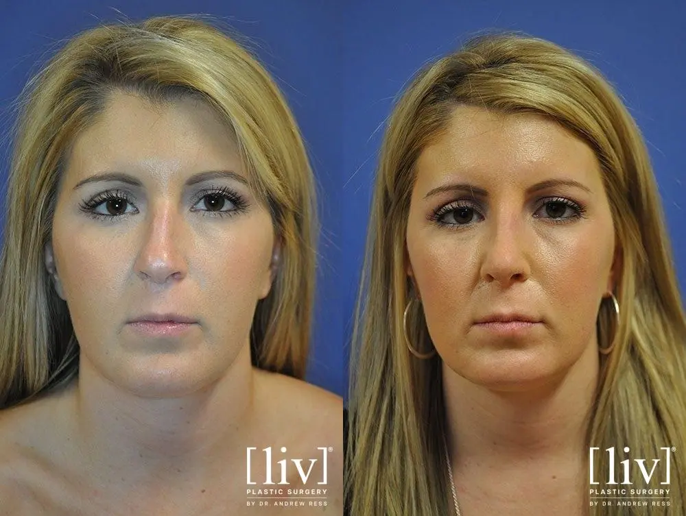 Rhinoplasty: Patient 18 - Before and After 1