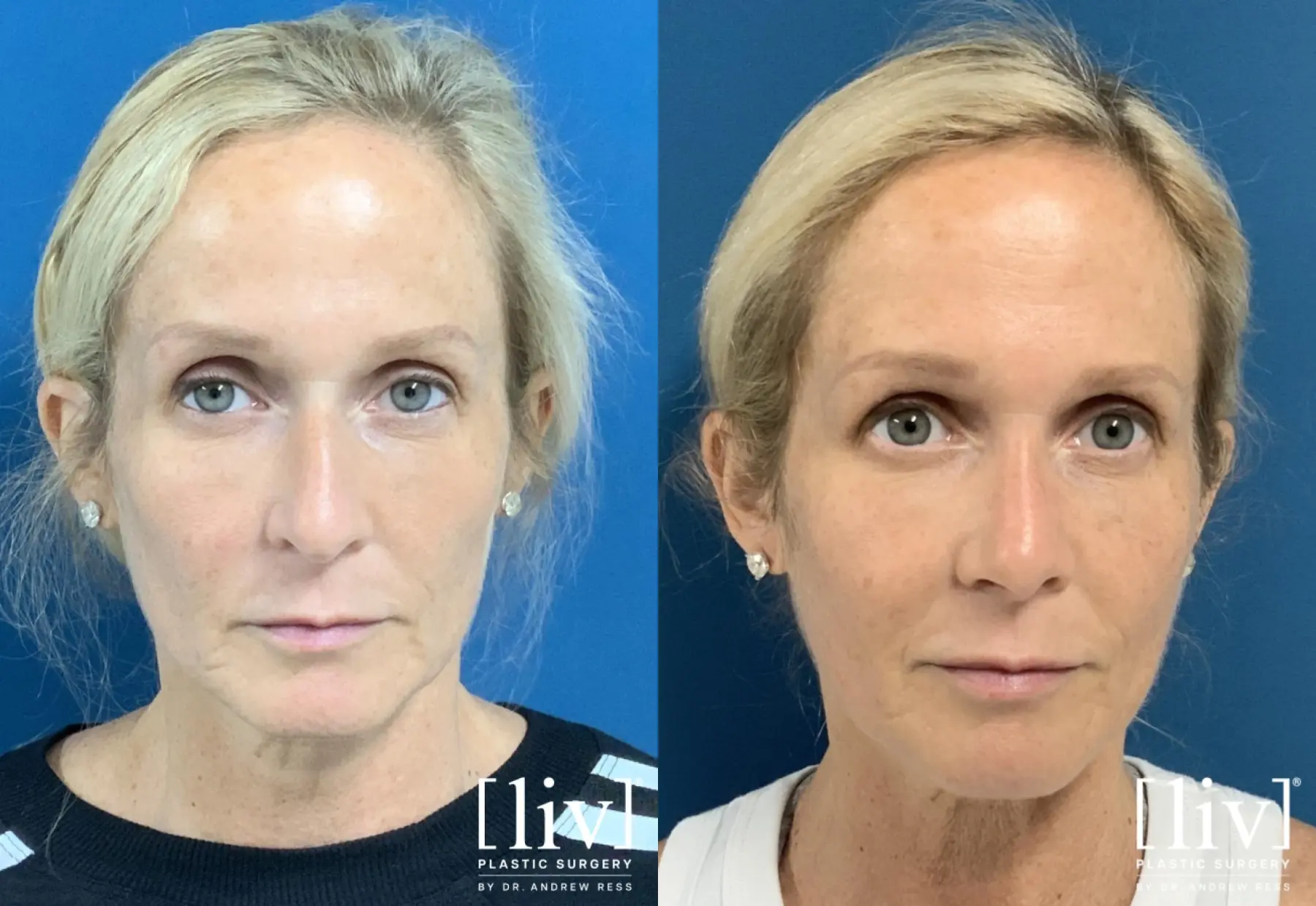 Rhinoplasty: Patient 3 - Before and After 3