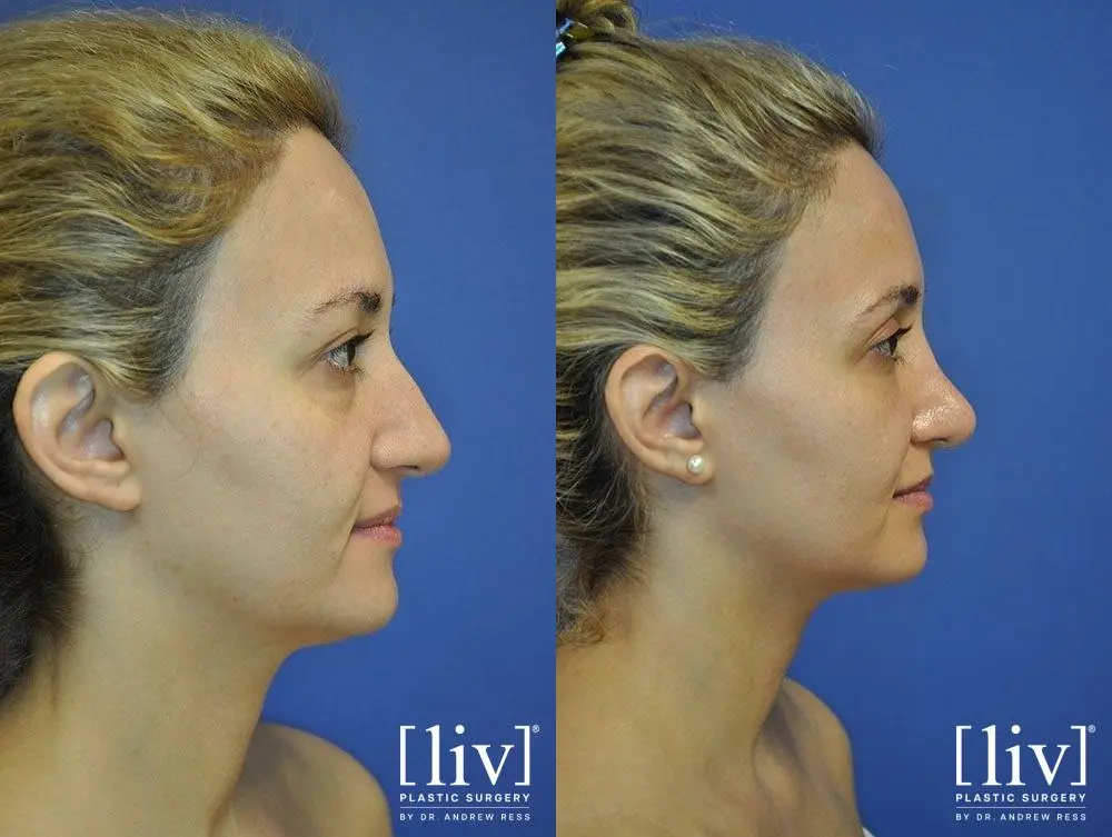 Rhinoplasty: Patient 13 - Before and After 3